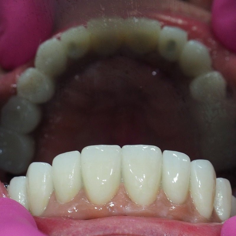 A Comprehensive Guide to Dental Zirconia Blocks - CeraDirect