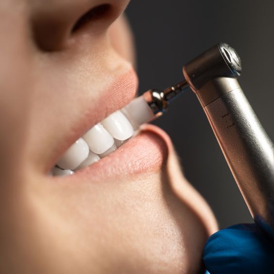 Effect of polishing on the abrasion between zirconia or cobalt-chromium alloy restoration and natural tooth - CeraDirect