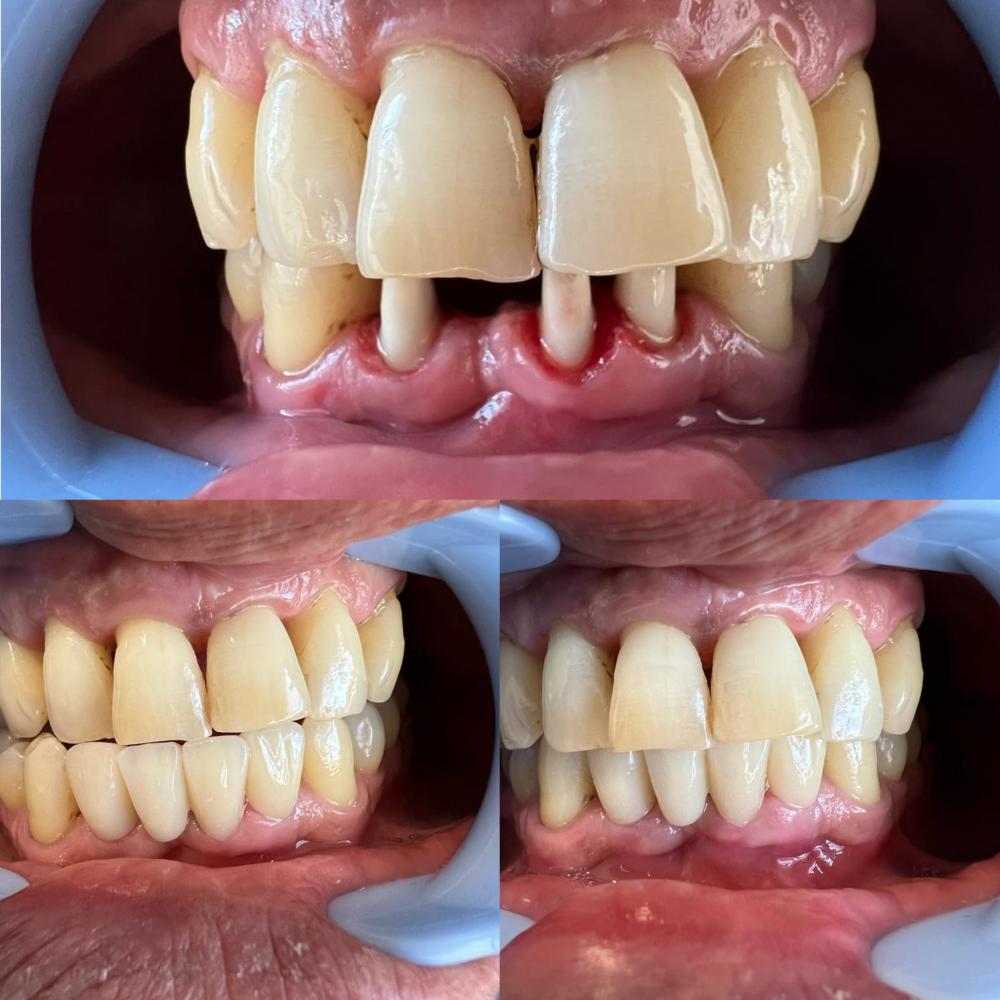 The Advancement of Dentistry through Dental Zirconia Blocks: Revolutionizing Prosthetic Fabrication - CeraDirect