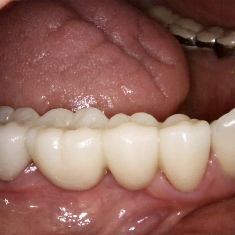 The Benefits of CAD/CAM Blocks in the Field of Dentistry - CeraDirect